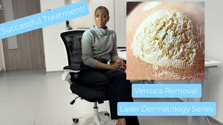 Verruca Wart Removal Laser Treatment [upl. by Notsirk]