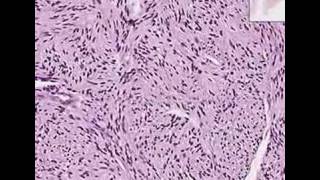 Histopathology SkinPalisaded Encapsulated Neuroma solitar [upl. by Atalanti]