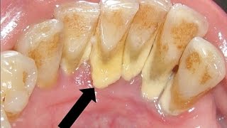 how teeth cleaning or scaling done by dentist explained in tamil [upl. by Lavine409]