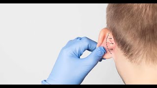 Otoplasty Recovery Day by Day  Ear Surgery Recovery  Lyfboat [upl. by Prisilla]