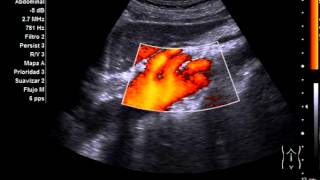 Aneurisma de aorta abdominal [upl. by Eimarrej]