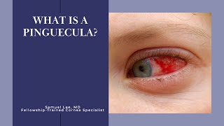 What is a Pinguecula [upl. by Nosahc]