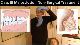 Correcting Class III Malocclusion without Tooth Extraction or Oral Surgery by Prof John Mew [upl. by Ynatterb]