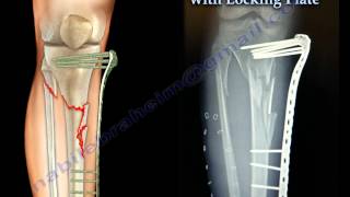 External Fixation With Locking Plate  Everything You Need To Know  Dr Nabil Ebraheim [upl. by Rdnaskela]