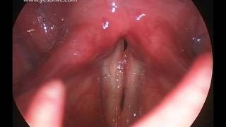 Laryngeal Papillomas 4893 [upl. by Ivel]