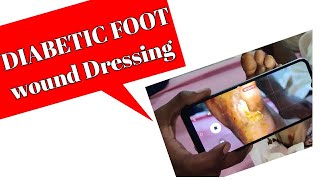 Diabetic foot l Diabetic foot Dressing l Diabetic foot care । foot ulcer treatment in hindi [upl. by Gnad520]