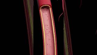 Atherosclerosis The Silent BuildUp [upl. by Endora]