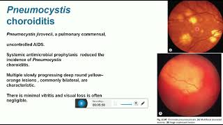 fungal uveitis [upl. by Calderon]