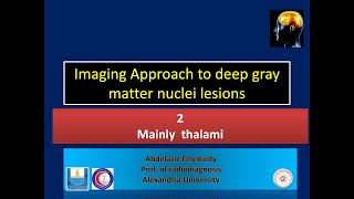 thalamic lesions [upl. by Anitsirc548]