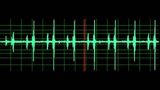 Pulmonary Associated Heart Sounds PAH Split S2 [upl. by Nyladam297]