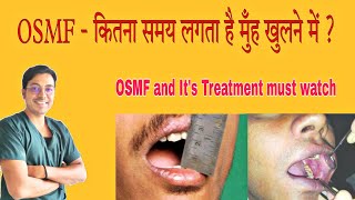 OSMF  कितने दिनों में मुँह खुलेगा   Oral Submucous Fibrosis In Hindi  OSMF in Hindi [upl. by Dulci591]