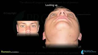 Orthognathic Jaw surgery amp oral and maxillofacial surgery using CT 3D imaging [upl. by Remlap]