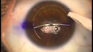 Removal of epithelial downgrowth after LASIK [upl. by Marje]