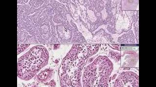 Histopathology TestisEndodermal sinus tumor yolk sac tumo [upl. by Lew981]