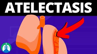 Atelectasis Medical Definition  Quick Explainer Video [upl. by Ttenna]