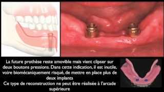 Prothèse amovible et implants dentairesMandibular overdentures [upl. by Barth]