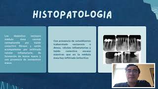 Osteitis Condensante [upl. by Esorlatsyrc]