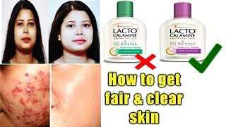 Lacto Calamine lotion reviewusesbenefitshow to get clear and fair skin [upl. by Htebazile]