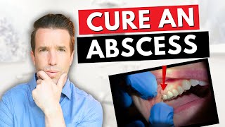 Dentist Explains a Tooth Abscess  How to Cure an Abscess Tooth [upl. by Gnilrac]