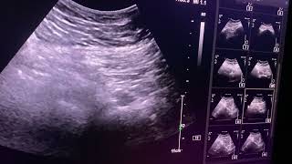 Muscle hematoma posterior hip sacrospinous region usghiphematoma pain [upl. by Paget]