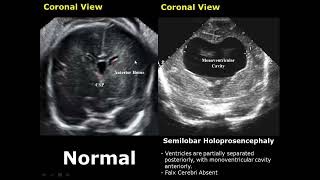 Fetal Brain Ultrasound Normal Vs Abnormal Image Appearances Comparison  Fetal Brain Pathologies USG [upl. by Endo]