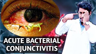 acute mucopurulent conjunctivitis acute bacterial conjunctivitis conjunctivitis in the eye 2021 [upl. by Odranar]