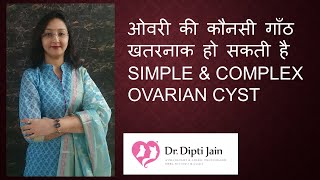 OVARIAN CYST  SIMPLE amp COMPLEX ओवरी की गाँठ Which one is dangerous [upl. by Applegate]