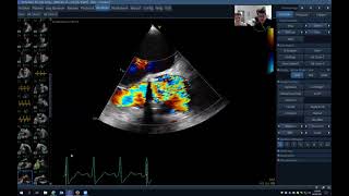 Infective Endocarditis in Bioprosthetic AVR [upl. by Kerrie]