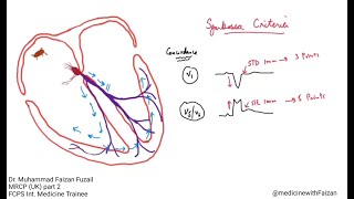 How to diagnose myocardial infarction in LBBB – Sgarbossa Criteria [upl. by Schulein]