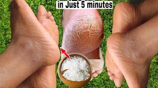 HOW TO REMOVE DEAD SKIN FROM YOUR FEET NATURALLY AT HOME 2024 CRACKED HEELS HOME REMEDY [upl. by Suhpoelc]