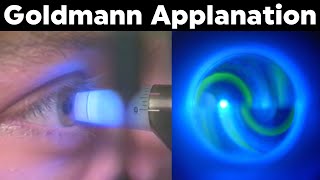 Goldmann Applanation Tonometry Procedure Technique Tutorial [upl. by Erek90]