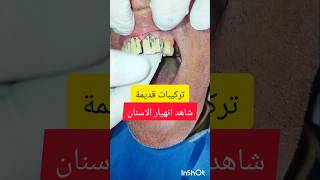 ازالة تركيبات قديمة من البورسلان شاهد قبل وبعد dentist stitch اكسبلور stitchlover ترند [upl. by Elleynad]