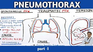 Pneumothorax pathophysiology in Hindi  part1 [upl. by Karim]