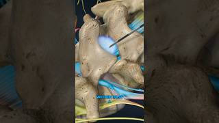 Lumbar Epidural Steroid Injection 3D Animation [upl. by Peppy610]