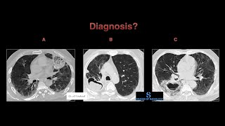 3 Classic signs of Fungal infections in chest [upl. by Clementius]