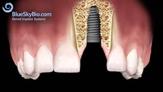 Patient Treatment Videos Implants [upl. by Sucerdor]