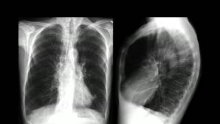 ENFISEMA PULMONAR [upl. by Yrem]