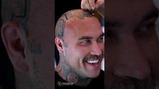 Hair Transplant Turkey hairtrasnplantturkey hairtransplant nowhairtime [upl. by Syman]