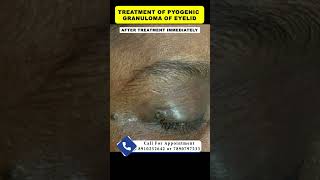 Treatment of pyogenic granuloma  By Dr Uttam Kumar Lenka MBBS MD Consultant Dermatologist [upl. by Aria56]