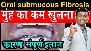 मुंह का कम खुलना कारण संपूर्ण इलाज oral submucous fibrosis I difficult to open mouth hind [upl. by Aseretairam498]