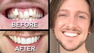 INVISALIGN REVIEW  everything you need to know [upl. by Luhem56]