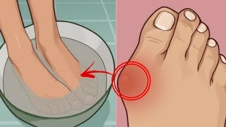 Home Remedies for Bunions  5 Incredible Natural Cure For Bunions [upl. by Iahk547]