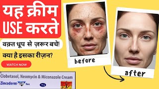 Zincoderm GM Neo Ointment Review  Clobetasol Miconazole amp Neomycin Benefits [upl. by Siravrat922]