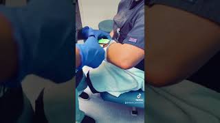 ULNAR GUTTER CAST REMOVAL 😀 [upl. by Rawdin]