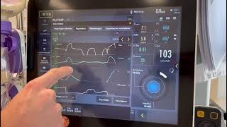 Het berekenen van de occlusie druk en predicted transpulmonaal druk ServoU [upl. by Kariotta]