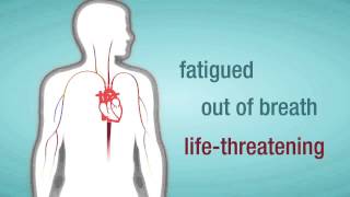 Valve Regurgitation When a Heart Valve Leaks [upl. by Furlong]