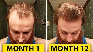 How To Reverse Hair Loss In 12 Months [upl. by Xer98]