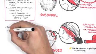 Intracranial Haemorrhage Types signs and symptoms [upl. by Maller111]