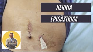 Hernia Epigástrica y Drenaje [upl. by Bodkin]