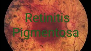 Retinitis pigmentosa RP treatment signs symptoms discussion  Simple version [upl. by Graces545]